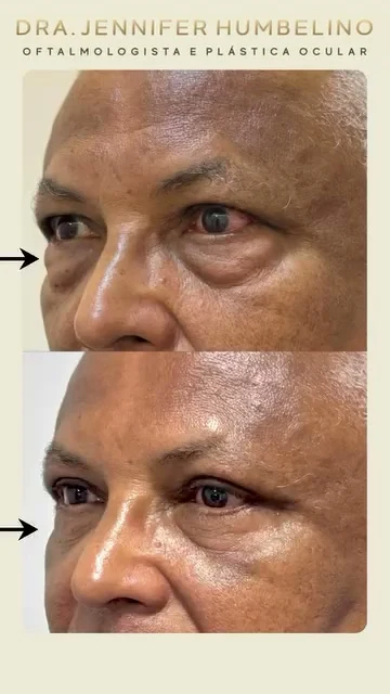 Registro comparativo de evolução pós-operatória em paciente masculino submetido a blefaroplastia e cantopexia